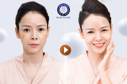 Meso Extra Không Kim - Công Nghệ Đỉnh Cao Cho Làn Da Không Tuổi